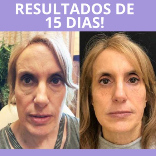 Botoxlaser 4 em 1 - Acabe com as Rugas em 7 dias + Brinde exclusivo